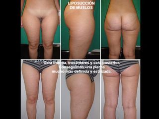Antes y después Liposucción