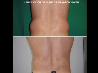 Antes y después Liposucción