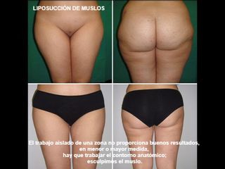 Antes y después Liposucción