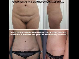 Antes y después Abdominoplastia