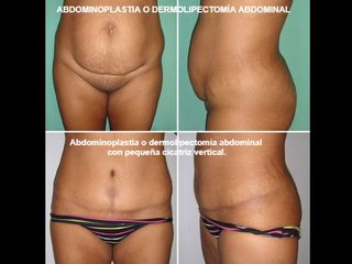 Antes y después Abdominoplastia