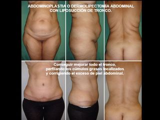 Antes y después Abdominoplastia