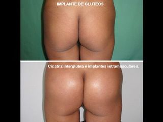 Antes y después Aumento de glúteos