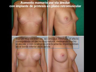 Antes y después Aumento de pecho