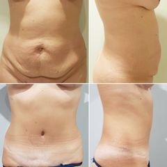 Antes y después Abdominoplastia
