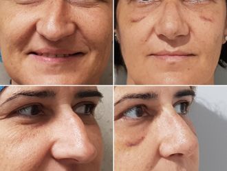 Eliminación ojeras - 646521