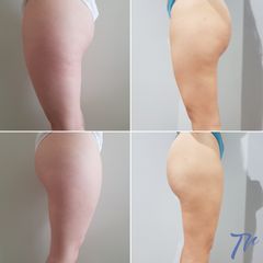 Antes y después Liposucción - Dr. José María Triviño Fernández