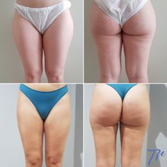 Antes y después Liposucción - Dr. José María Triviño Fernández