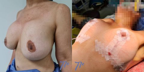 Cirugía mamaria secundaria - Dr. José María Triviño Fernández