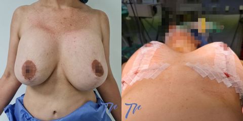 Cirugía mamaria secundaria - Dr. José María Triviño Fernández