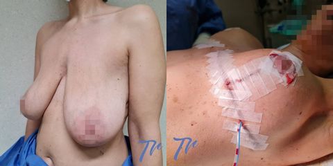 Mastopexia - Dr. José María Triviño Fernández