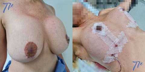 Cirugía mamaria secundaria - Dr. José María Triviño Fernández