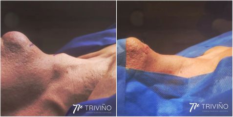 Tiroplastia - Dr. José María Triviño Fernández