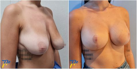 Mastopexia - Dr. José María Triviño Fernández
