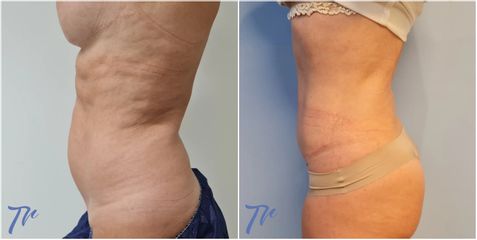 Abdominoplastia - Dr. José María Triviño Fernández