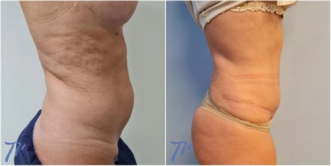 Abdominoplastia - Dr. José María Triviño Fernández