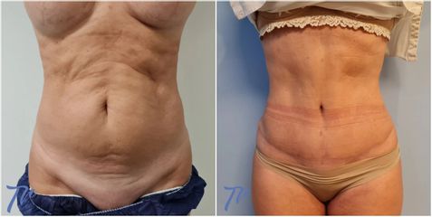 Abdominoplastia - Dr. José María Triviño Fernández