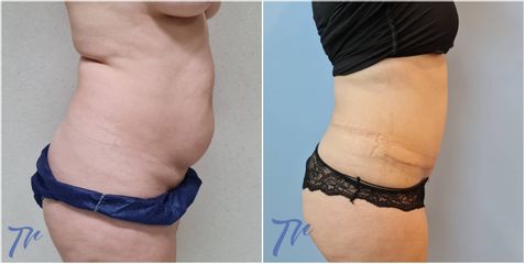 Abdominoplastia - Dr. José María Triviño Fernández