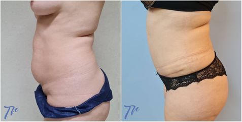 Abdominoplastia - Dr. José María Triviño Fernández