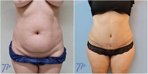 Abdominoplastia - Dr. José María Triviño Fernández
