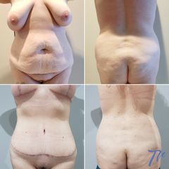 Abdominoplastia - Dr. José María Triviño Fernández