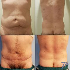 Abdominoplastia - Dr. José María Triviño Fernández