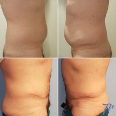 Abdominoplastia - Dr. José María Triviño Fernández