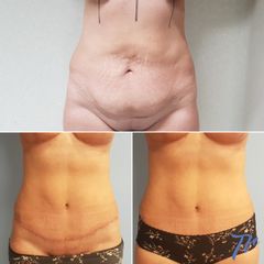 Abdominoplastia - Dr. José María Triviño Fernández