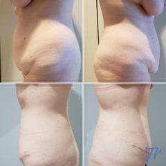 Abdominoplastia - Dr. José María Triviño Fernández