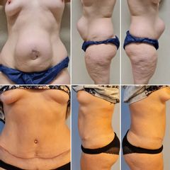 Abdominoplastia - Dr. José María Triviño Fernández