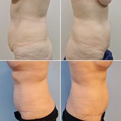 Abdominoplastia - Dr. José María Triviño Fernández