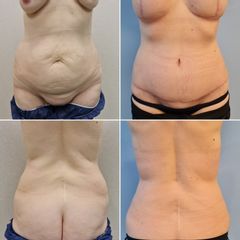 Abdominoplastia - Dr. José María Triviño Fernández