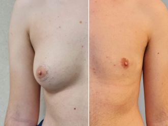 Cambio de sexo antes y después - 844120