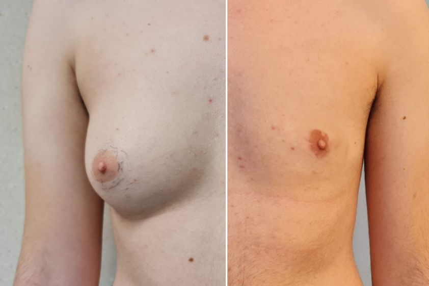 Cambio de sexo antes y después - 844120