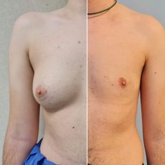 Masculinización torácica - Dr. José María Triviño Fernández