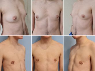 Cambio de sexo antes y después - 844121