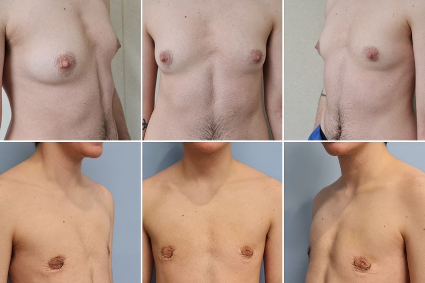 Cambio de sexo antes y después - 844121