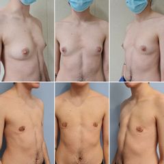 Masculinización torácica - Dr. José María Triviño Fernández