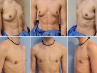 Cambio de sexo antes y después - 844122