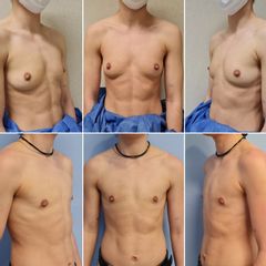 Masculinización torácica - Dr. José María Triviño Fernández
