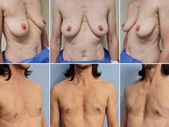 Cambio de sexo antes y después - 844123