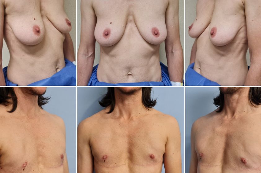 Cambio de sexo antes y después - 844123