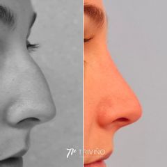 Rinoplastia - Dr. José María Triviño Fernández