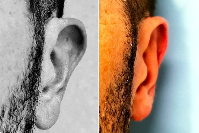 Otoplastia antes y después - 851675