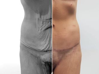 Cirugía reconstructiva antes y después - 851896