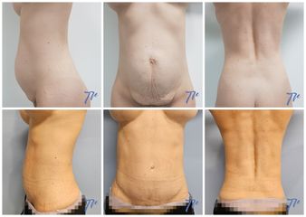 Abdominoplastia - Dr. José María Triviño Fernández