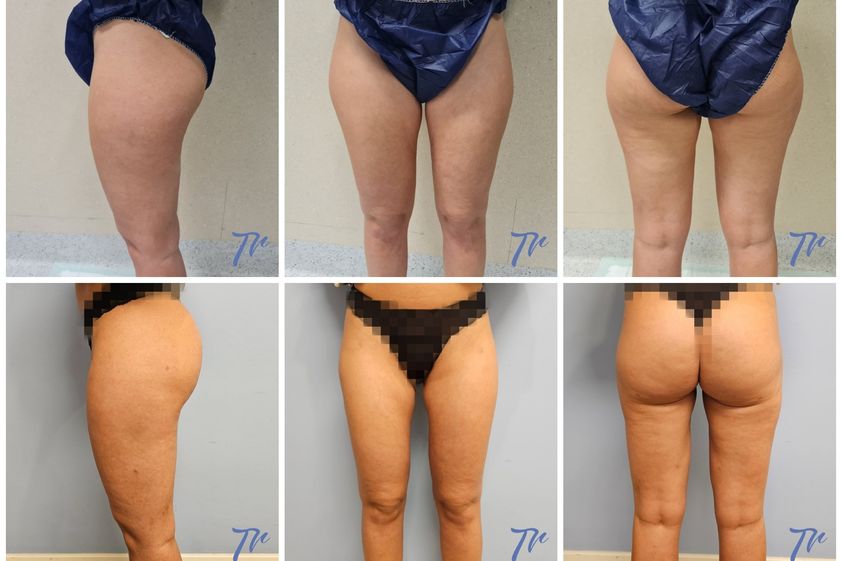 Liposucción antes y después - 860837
