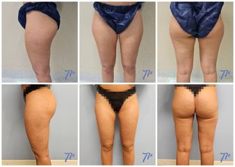 Liposucción - Dr. José María Triviño Fernández