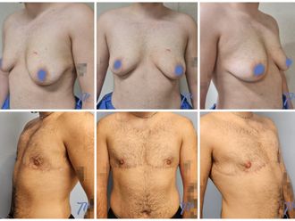 Cambio de sexo antes y después - 860839