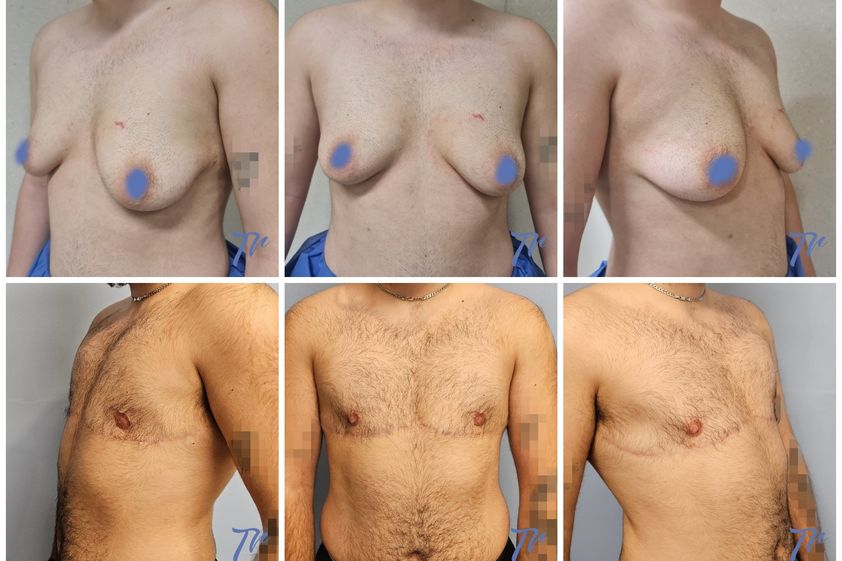 Cambio de sexo antes y después - 860839